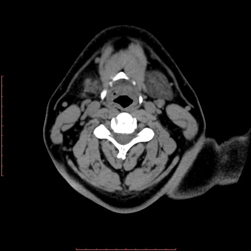 File:Chronic submandibular sialolithiasis (Radiopaedia 69817-79814 Axial non-contrast 137).jpg