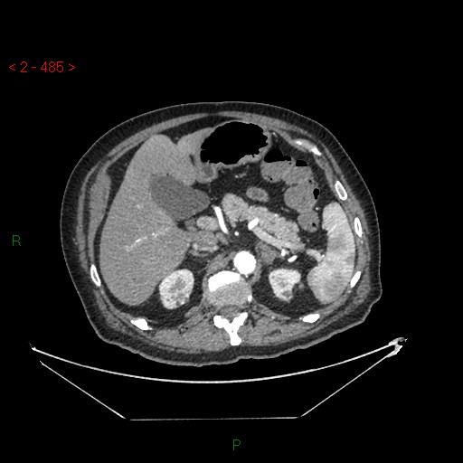 Circumaortic left renal vein and doubled left renal arteries (Radiopaedia 52268-58158 A 21).jpg