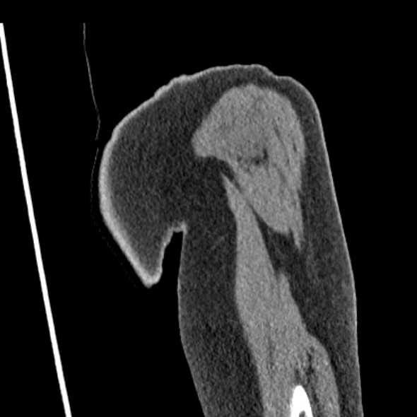 Clear cell chondrosarcoma - humerus (Radiopaedia 63104-71612 Coronal non-contrast 7).jpg