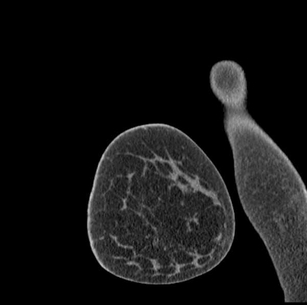 Clear cell chondrosarcoma - humerus (Radiopaedia 63104-71612 D 2).jpg