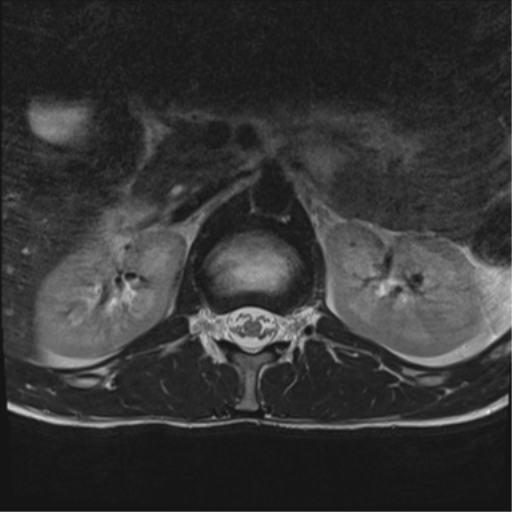 File:Clear cell meningoma - lumbar spine (Radiopaedia 60116-67690 Axial T2 41).png