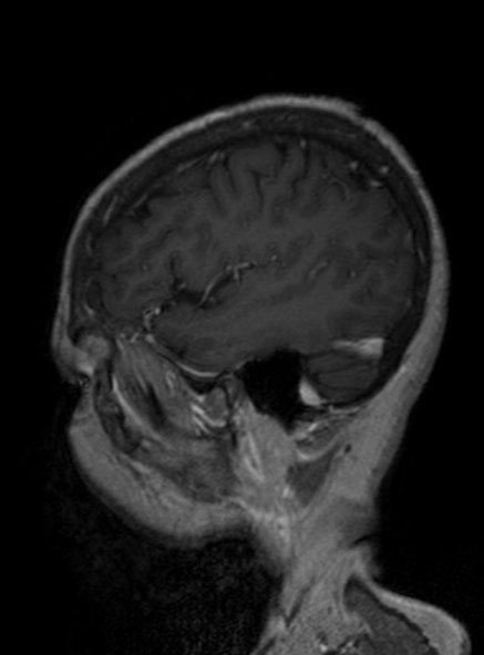 Clival meningioma (Radiopaedia 53278-59248 Sagittal T1 C+ 342).jpg