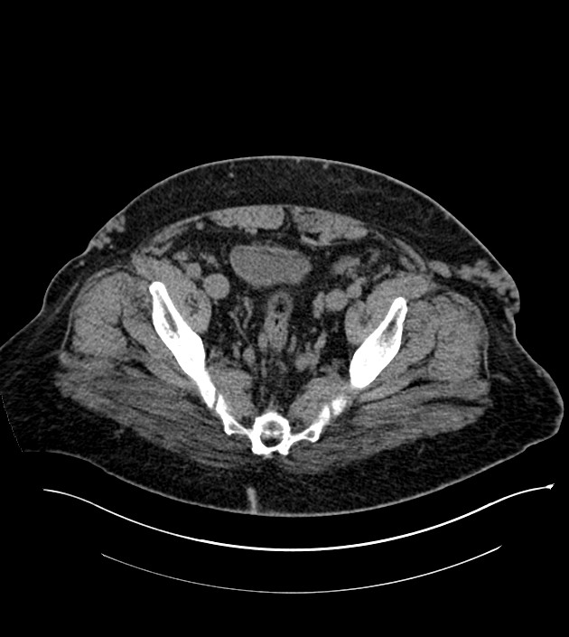 Closed-loop small bowel obstruction-internal hernia (Radiopaedia 78439-91096 Axial non-contrast 132).jpg