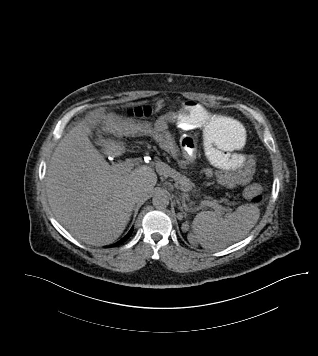 Closed-loop small bowel obstruction-internal hernia (Radiopaedia 78439-91096 Axial non-contrast 38).jpg