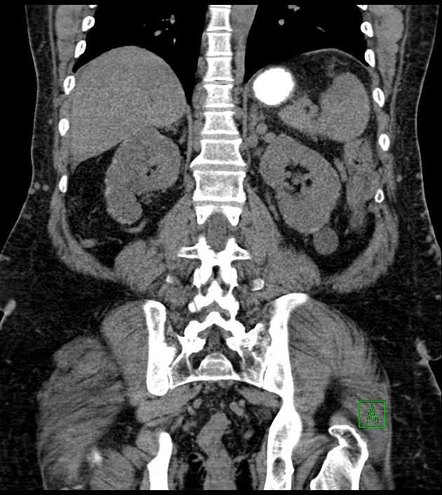 Closed-loop small bowel obstruction-internal hernia (Radiopaedia 78439-91096 Coronal non-contrast 73).jpg