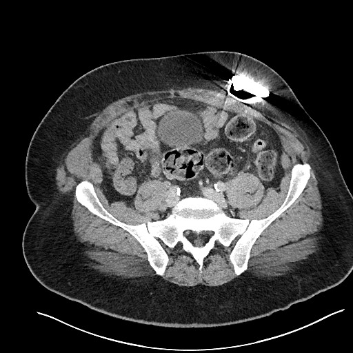 File:Closed loop obstruction - internal hernia into nephrectomy bed (Radiopaedia 59867-67320 A 103).jpg