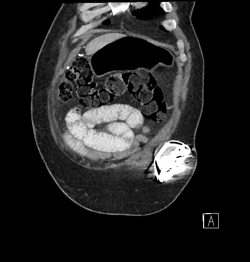 File:Closed loop obstruction - internal hernia into nephrectomy bed (Radiopaedia 59867-67320 B 11).jpg