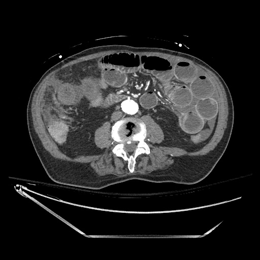 File:Closed loop obstruction due to adhesive band, resulting in small bowel ischemia and resection (Radiopaedia 83835-99023 Axial 223).jpg