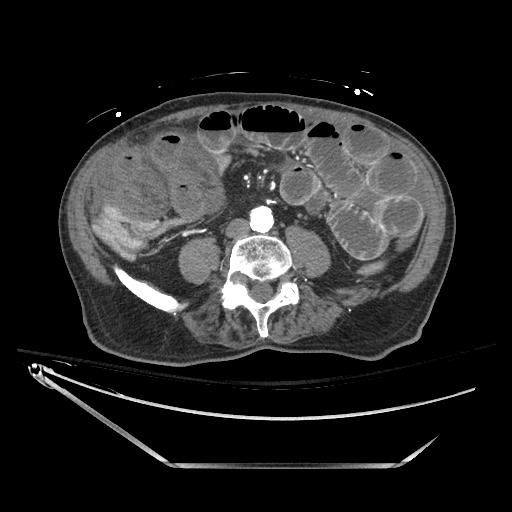 Closed loop obstruction due to adhesive band, resulting in small bowel ischemia and resection (Radiopaedia 83835-99023 B 91).jpg