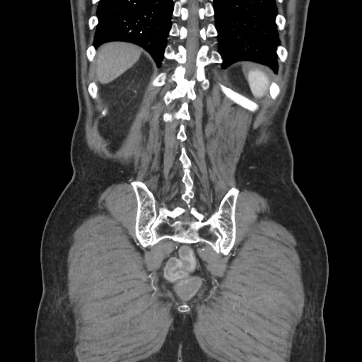 File:Closed loop obstruction due to adhesive band, resulting in small bowel ischemia and resection (Radiopaedia 83835-99023 C 103).jpg