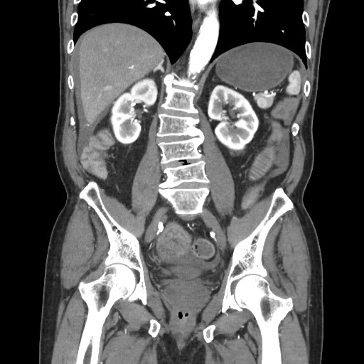 File:Closed loop obstruction due to adhesive band, resulting in small bowel ischemia and resection (Radiopaedia 83835-99023 C 78).jpg