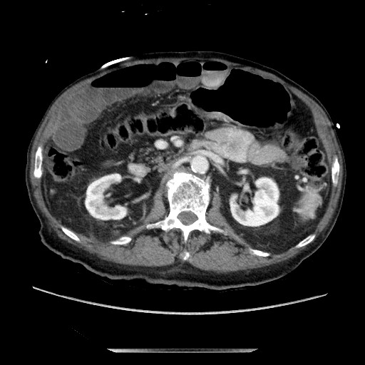 Closed loop small bowel obstruction - adhesive disease and hemorrhagic ischemia (Radiopaedia 86831-102990 A 82).jpg