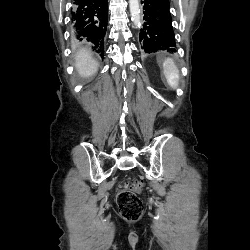 Closed loop small bowel obstruction - adhesive disease and hemorrhagic ischemia (Radiopaedia 86831-102990 B 106).jpg