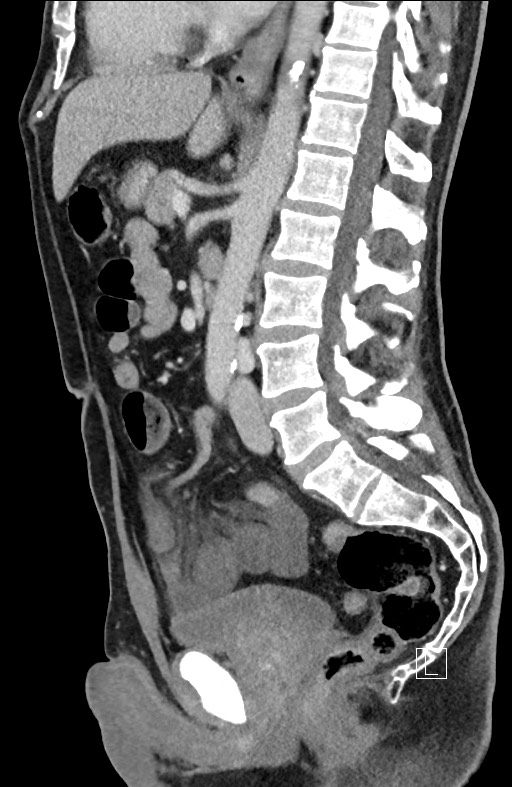 Closed loop small bowel obstruction - internal hernia (Radiopaedia 57806-64778 C 57).jpg
