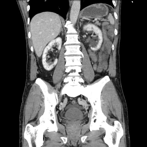Closed loop small bowel obstruction - omental adhesion causing "internal hernia" (Radiopaedia 85129-100682 B 82).jpg