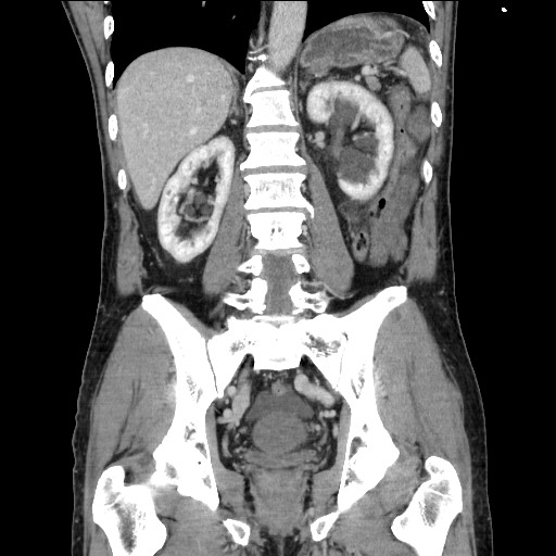 Closed loop small bowel obstruction - omental adhesion causing "internal hernia" (Radiopaedia 85129-100682 B 85).jpg