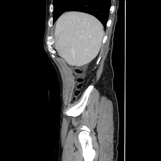 Closed loop small bowel obstruction - omental adhesion causing "internal hernia" (Radiopaedia 85129-100682 C 40).jpg