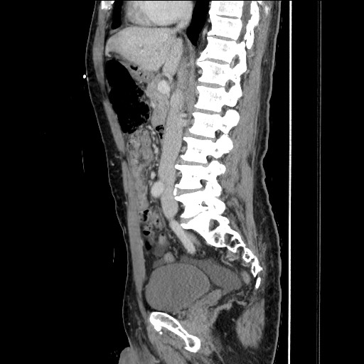 Closed loop small bowel obstruction - omental adhesion causing "internal hernia" (Radiopaedia 85129-100682 C 87).jpg