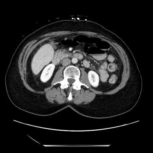 File:Closed loop small bowel obstruction due to adhesive bands - early and late images (Radiopaedia 83830-99014 A 64).jpg