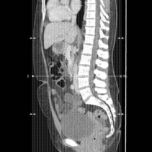 File:Closed loop small bowel obstruction due to trans-omental herniation (Radiopaedia 35593-37109 B 1).jpg