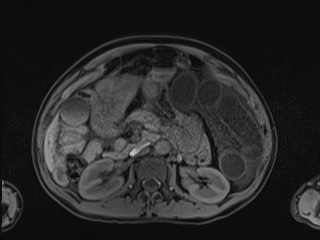 Closed loop small bowel obstruction in pregnancy (MRI) (Radiopaedia 87637-104031 Axial T1 fat sat 50).jpg