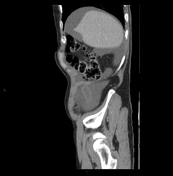 Closed loop small bowel obstruction with ischemia (Radiopaedia 84180-99456 C 17).jpg