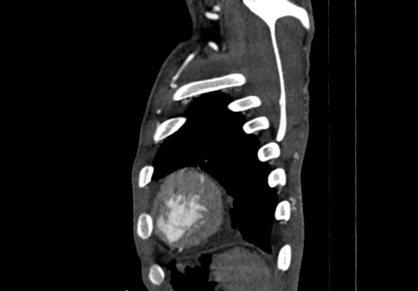 Coarctation of aorta with aortic valve stenosis (Radiopaedia 70463-80574 B 222).jpg