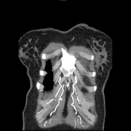 File:Coarctation of the aorta (Radiopaedia 67609-77010 B 60).jpg