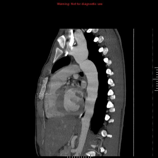 Coarctation of the aorta (Radiopaedia 9434-10118 B 36).jpg