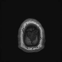 File:Cochlear incomplete partition type III associated with hypothalamic hamartoma (Radiopaedia 88756-105498 Axial T1 188).jpg