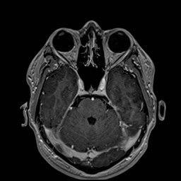 Cochlear incomplete partition type III associated with hypothalamic hamartoma (Radiopaedia 88756-105498 Axial T1 C+ 72).jpg