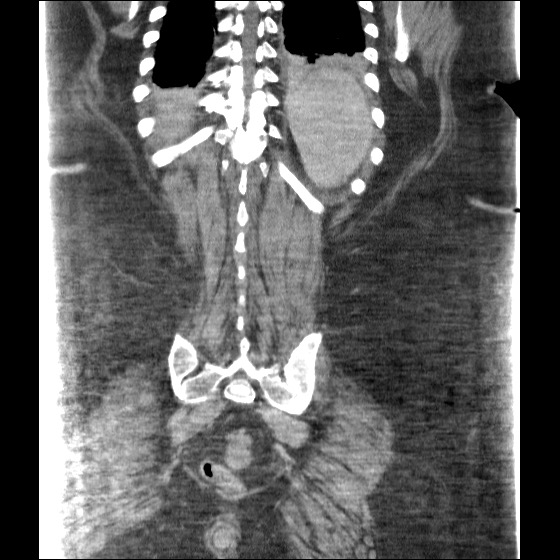 Collection due to leak after sleeve gastrectomy (Radiopaedia 55504-61972 B 38).jpg