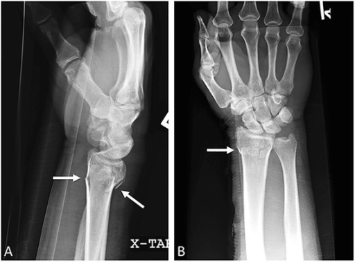 File:Colles fracture1.png
