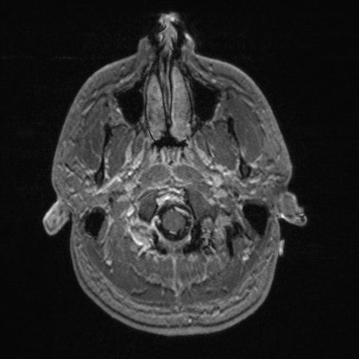 File:Colloid cyst (Radiopaedia 44510-48181 Axial T1 C+ 27).png