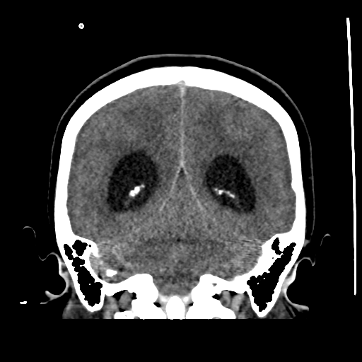 Colloid cyst (resulting in death) (Radiopaedia 33423-34469 Coronal non-contrast 38).png