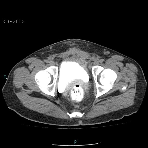 File:Colo-cutaneous fistula (Radiopaedia 40531-43129 A 88).jpg