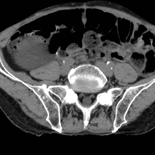 File:Colon cancer with calcified liver metastasis (Radiopaedia 74423-85309 Axial non-contrast 78).jpg