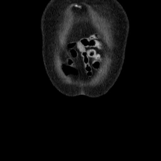 File:Colon cancer with duodenal invasion (Radiopaedia 16278-15958 B 2).jpg