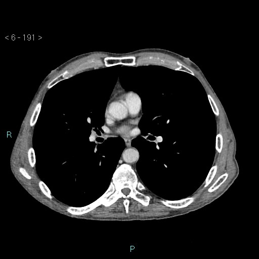 Colonic cancer (ultrasound and TC imaging) (Radiopaedia 50346-55713 B 191).jpg