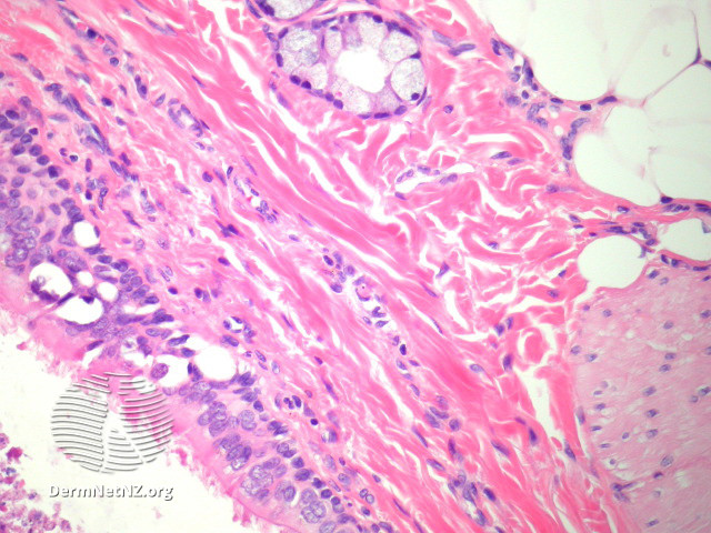 File:Figure 4 (DermNet NZ pathology-e-bronchogenic-cyst-figure-4).jpg