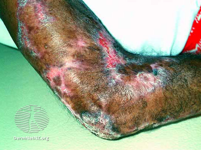 File:Lupus vulgaris (DermNet NZ bacterial-tb1).jpg