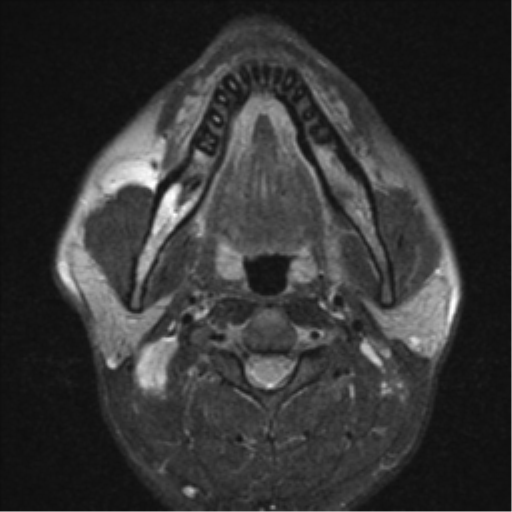 File:Nasopharyngeal carcinoma with pterygopalatine fossa involvement (Radiopaedia 33102-34134 Axial T2 7).png