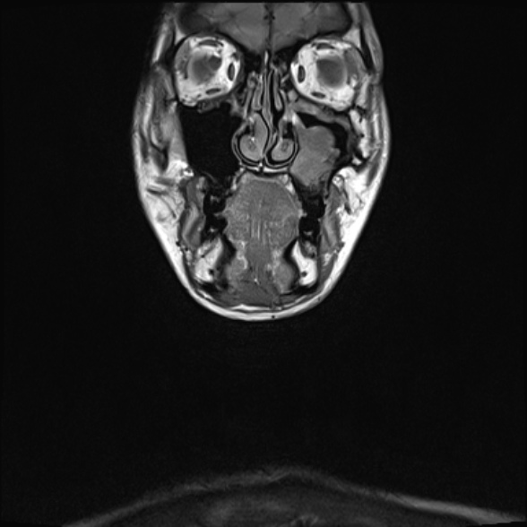 Nasopharyngeal carcinoma with skull base invasion (Radiopaedia 53415-59485 Coronal T1 35).jpg