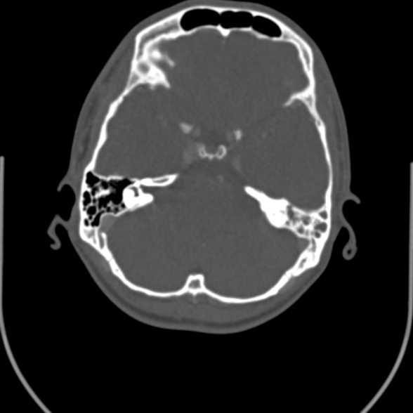 File:Nasopharyngeal carcinoma with skull base invasion (Radiopaedia 53415-59705 Axial bone window 3).jpg