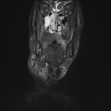Nasopharyngeal carcinoma with skull base invasion (Radiopaedia 59258-66600 Coronal T2 fat sat 27).jpg