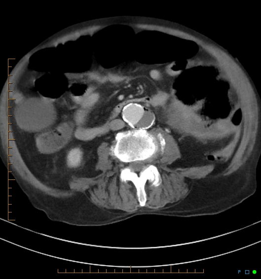 Necrotzing fasciitis due to a perforated adenocarcinoma of the splenic flexure (Radiopaedia 46930-51455 A 36).jpg