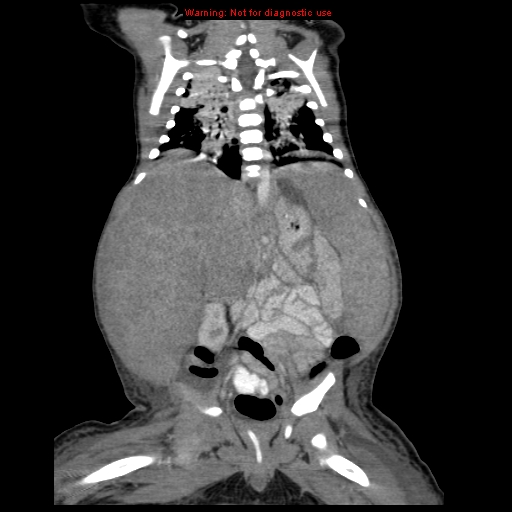 File:Neonatal neuroblastoma (Radiopaedia 9564-10223 B 81).jpg