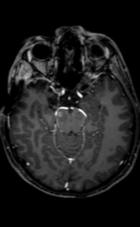 Neuro-Behçet disease (Radiopaedia 90112-107294 Axial T1 C+ 149).jpg