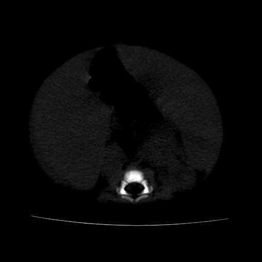 File:Neuroblastoma (Radiopaedia 20876-20799 Axial bone window 15).jpg