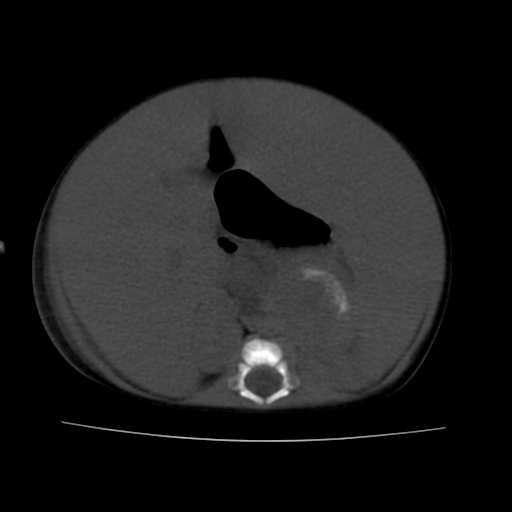 File:Neuroblastoma (Radiopaedia 20876-20799 Axial non-contrast 13).jpg